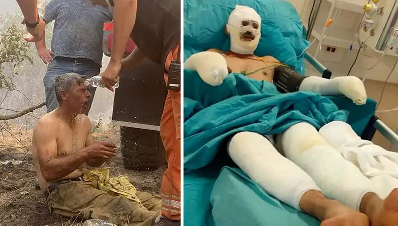 Orman İşçisinin Yanık Tedavisi: Yaşadığı Korkunç Kaza ve Sonrası