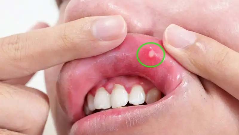 B Vitaminleri Eksikliği: Belirtileri ve Sağlığınıza Etkileri